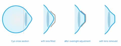 orthokeratology